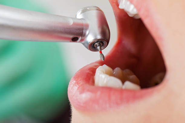 Best Emergency Dentist for Lost Fillings or Crowns in Red Hill, SC